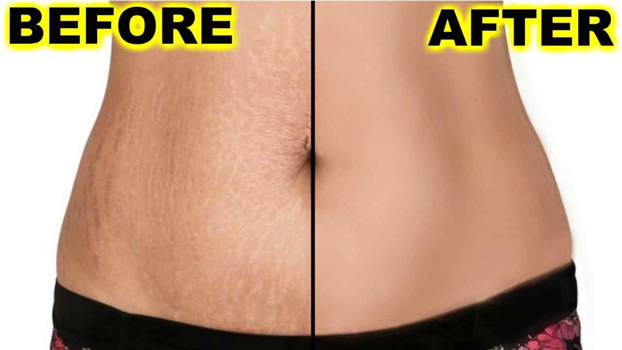 You may get stretch marks from weight lifting, during pregnancy, or rapid weight change.