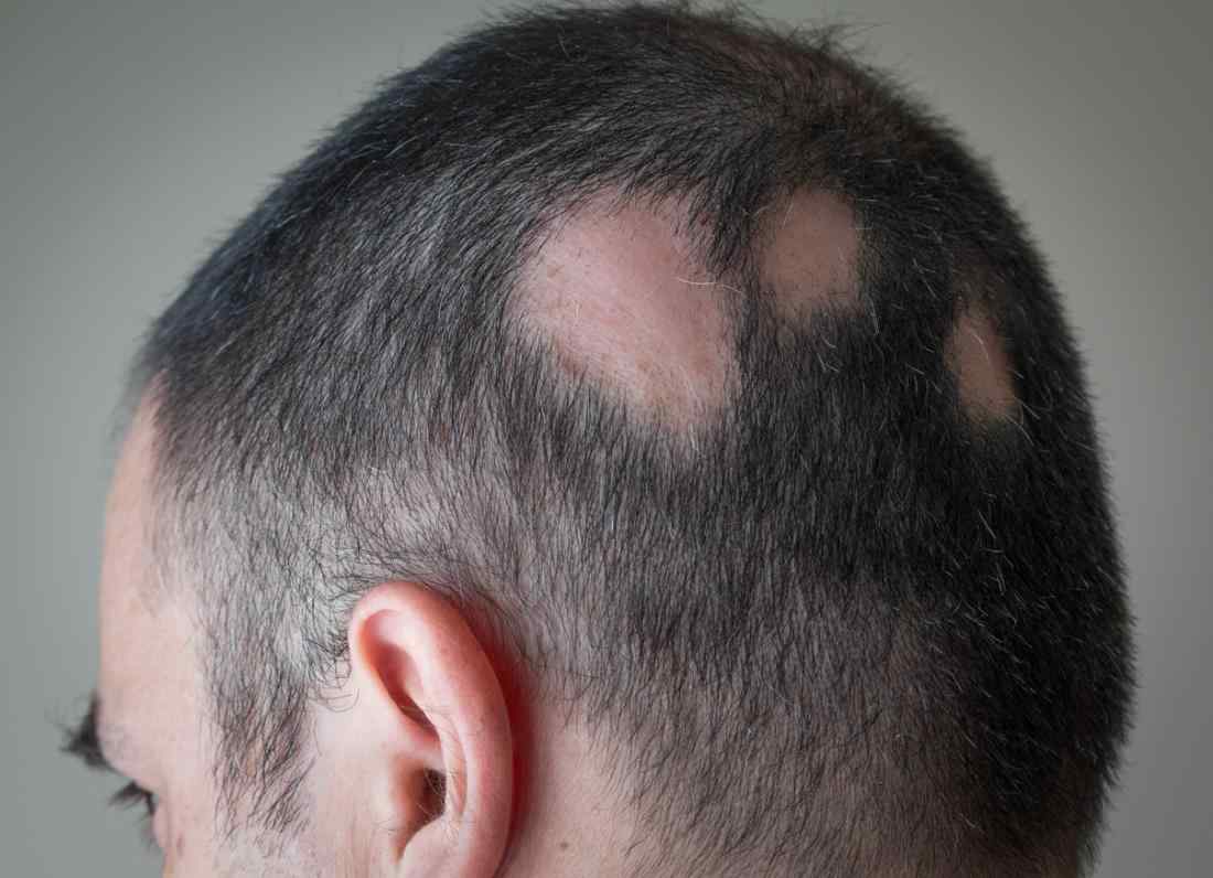 Alopecia means hair loss.