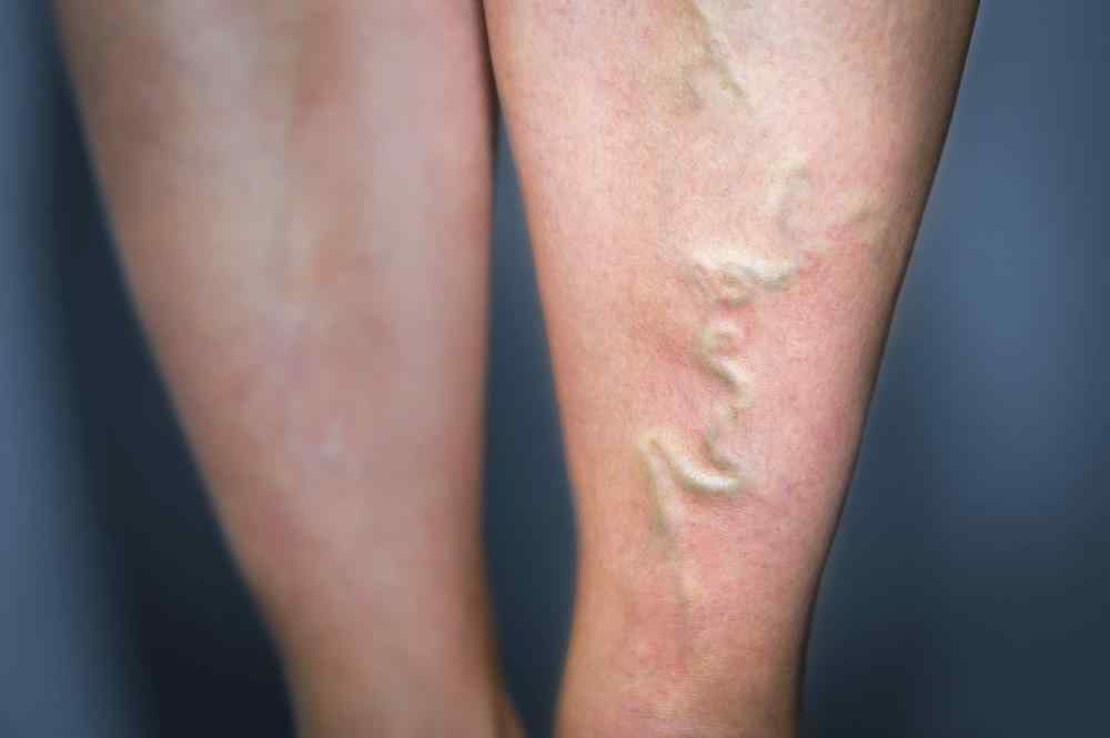 Varicose veins are enlarged and entangled veins.